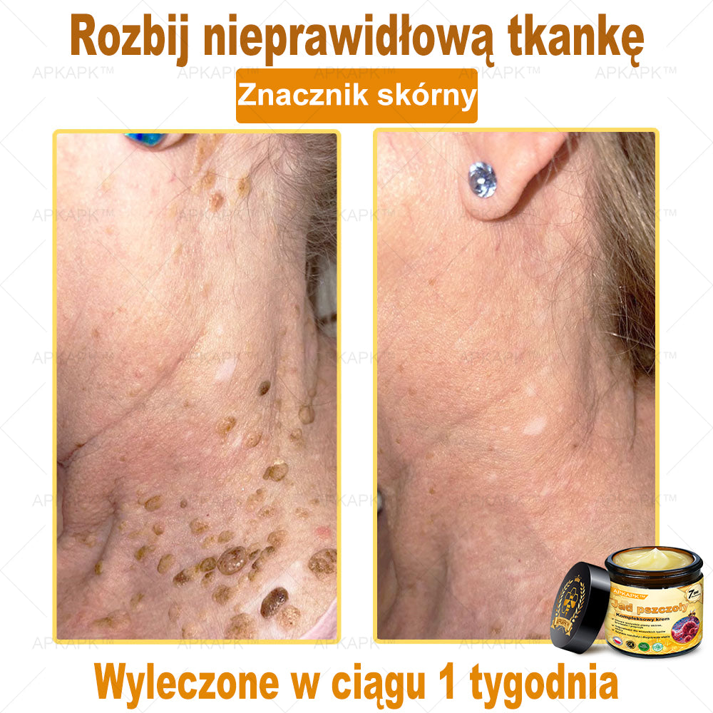 ΑPΚΑPK™ Jad Pszczoły Kompleksowy Krem🥇pomaga w leczeniu problemów skórnych, takich jak: zmarszczki, blizny, plamy pigmentacyjne, rozstępy, trądzik, łuszczyca, egzema, zmiany skórne, podrażnienia, stany zapalne i inne problemy skórne🔥