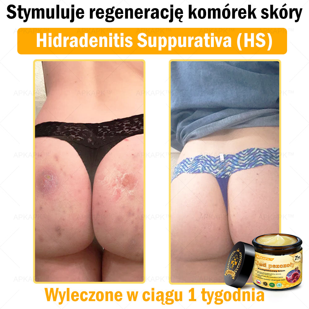 ΑPΚΑPK™ Jad Pszczoły Kompleksowy Krem🥇pomaga w leczeniu problemów skórnych, takich jak: zmarszczki, blizny, plamy pigmentacyjne, rozstępy, trądzik, łuszczyca, egzema, zmiany skórne, podrażnienia, stany zapalne i inne problemy skórne🔥